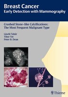 Breast Cancer: Early Detection With Mammography :crushed Stone-like Calcifications: The Most Frequent Malignant Ty
