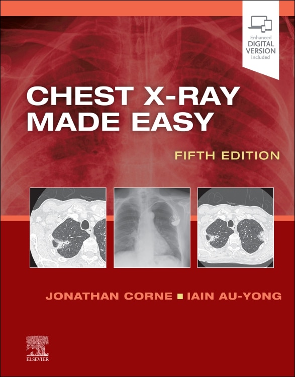 Chest X-ray Made Easy by Jonathan Corne, Paperback | Indigo Chapters