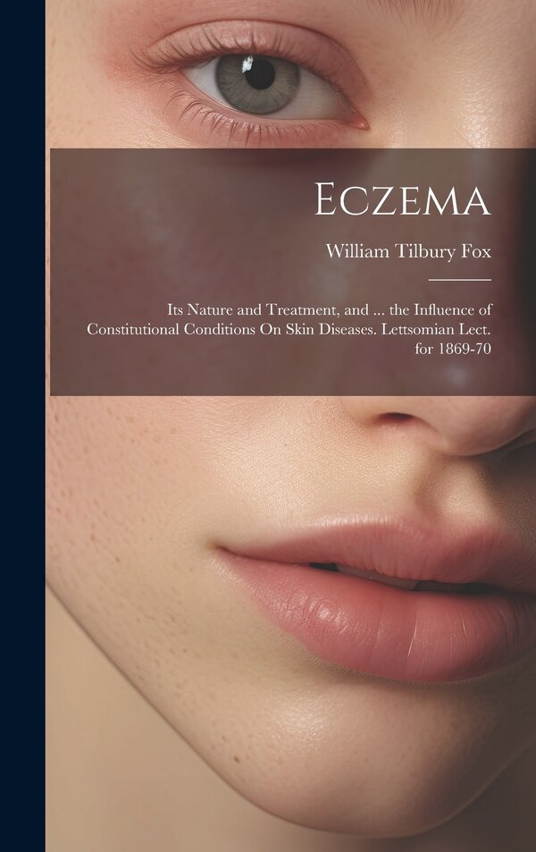 Eczema by William Tilbury Fox, Hardcover | Indigo Chapters