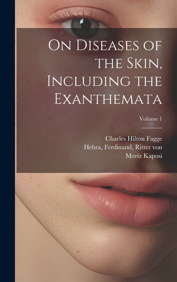 On Diseases of the Skin Including the Exanthemata; Volume 1 by Charles Hilton 1838-1883 Fagge, Hardcover | Indigo Chapters