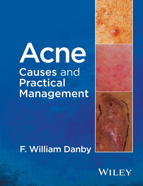 Acne by F. William Danby, Hardcover | Indigo Chapters