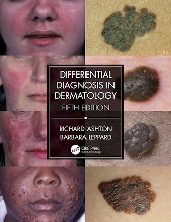 Differential Diagnosis In Dermatology