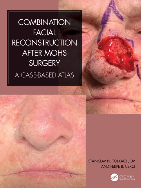Couverture_Combination Facial Reconstruction after Mohs Surgery