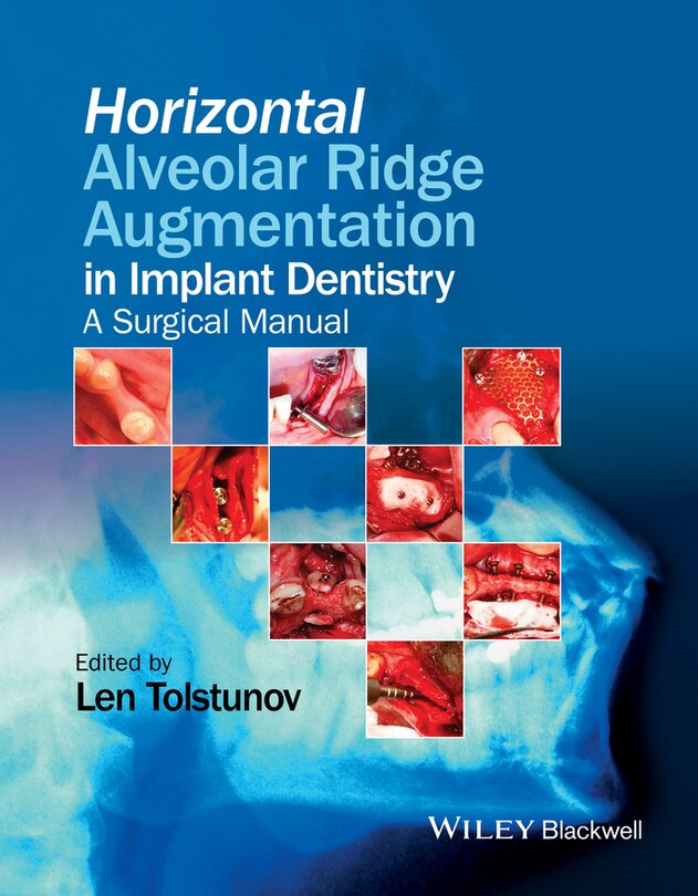 Front cover_Horizontal Alveolar Ridge Augmentation in Implant Dentistry