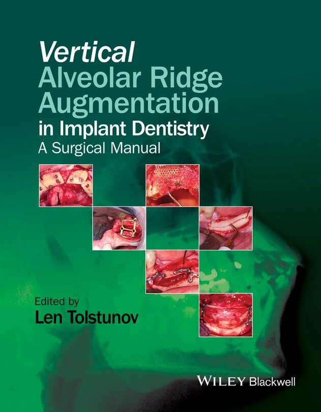 Couverture_Vertical Alveolar Ridge Augmentation in Implant Dentistry