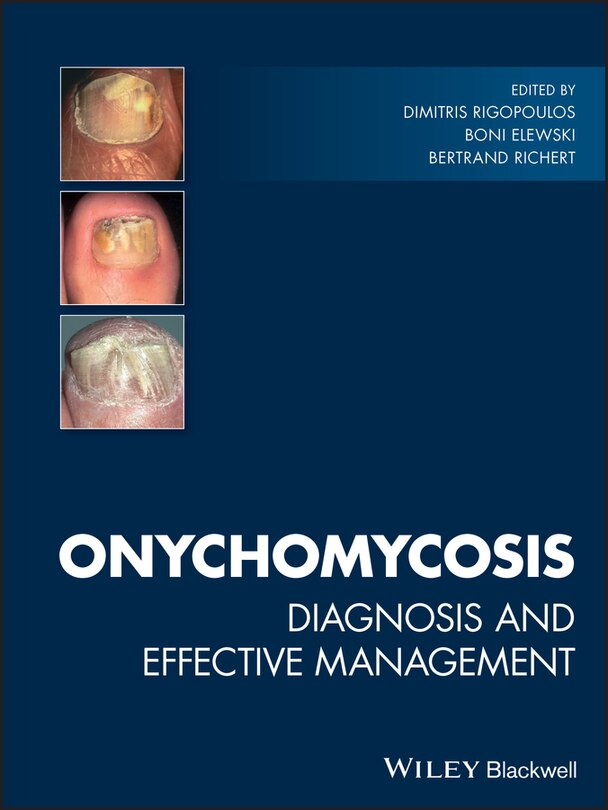 Front cover_Onychomycosis