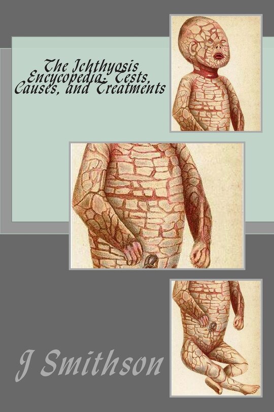 The Ichthyosis Encycopedia: Tests, Causes, and Treatments