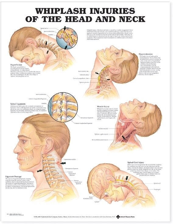 Front cover_Whiplash Injuries of the Head and Neck Anatomical Chart