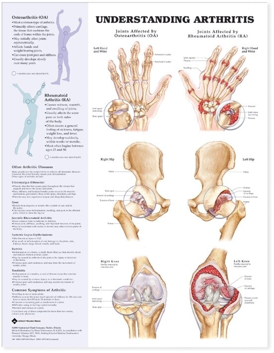 Front cover_Understanding Arthritis Anatomical Chart