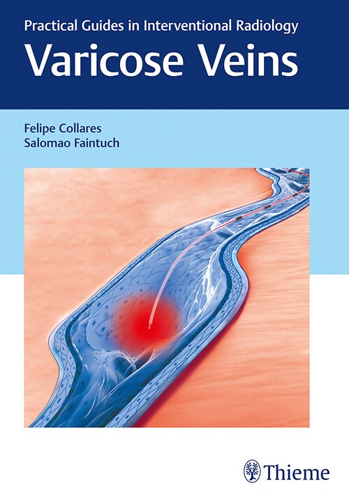 Front cover_Varicose Veins