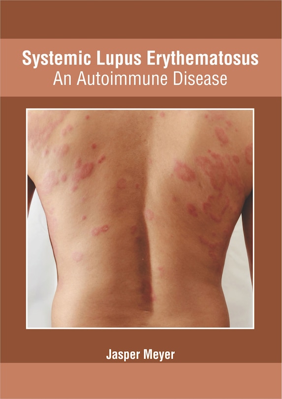 Systemic Lupus Erythematosus: An Autoimmune Disease