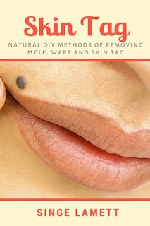 Skin Tag: Natural DIY Methods of removing Mole, Wart and Skin Tag