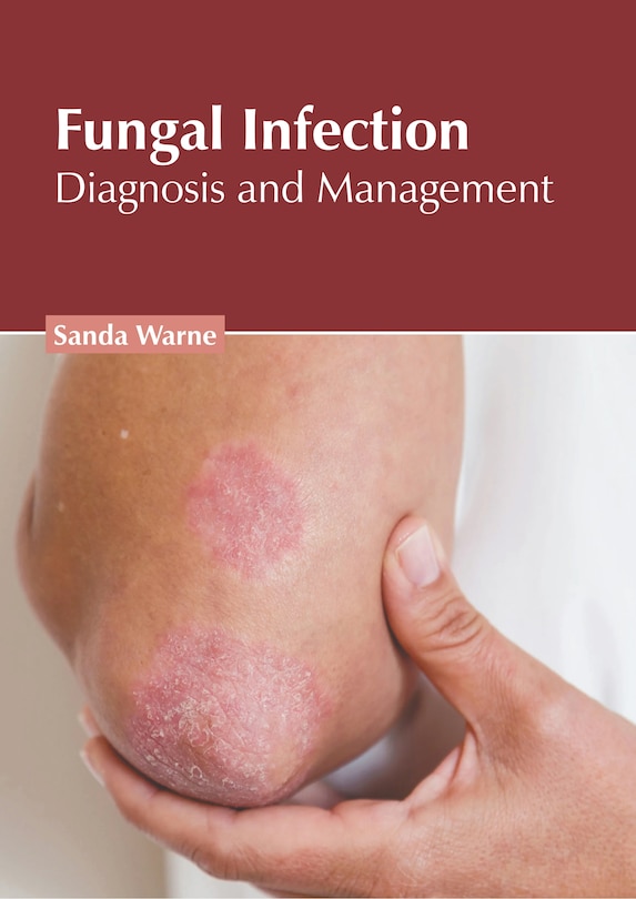 Front cover_Fungal Infection: Diagnosis and Management