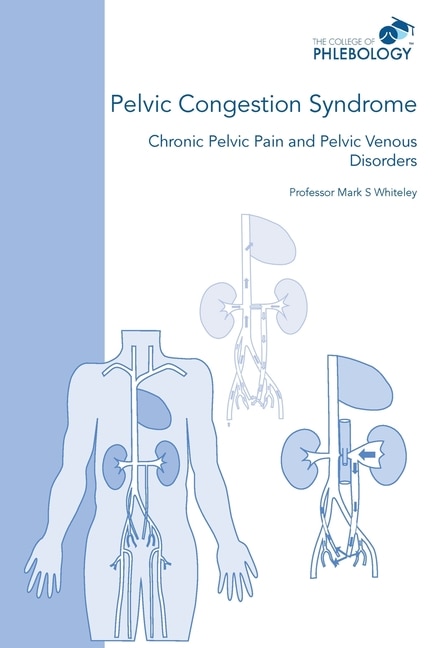Pelvic Congestion Syndrome - Chronic Pelvic Pain And Pelvic Venous Disorders
