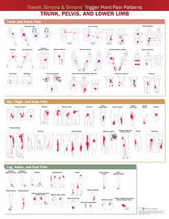 Travell, Simons And Simons' Trigger Point Pain Patterns Wall Chart: Trunk, Pelvis, And Lower Limb