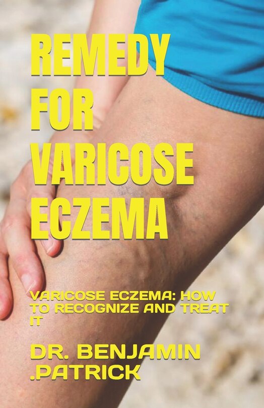 Remedy for Varicose Eczema: Varicose Eczema: How to Recognize and Treat It