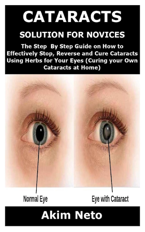 Front cover_Cataracts Solution for Novices