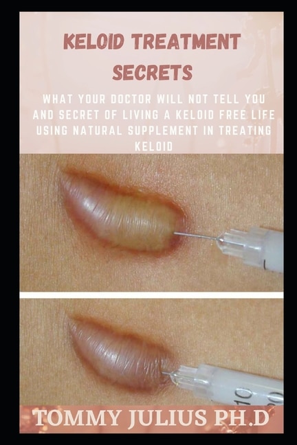 Keloid Treatment Secrets: What Your Doctor Will Not Tell You And Secret Of Living A Keloid Free Life Using Natural Supplement