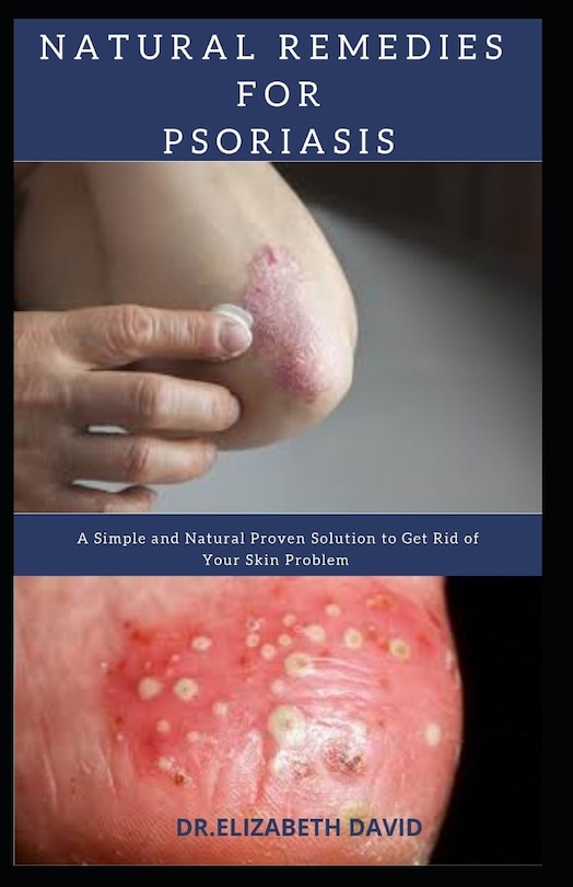 Couverture_Natural Remedies for Psoriasis