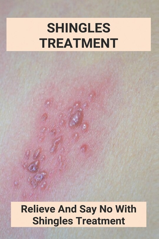 Couverture_Shingles Treatment